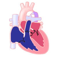 Coarctation of the aorta.